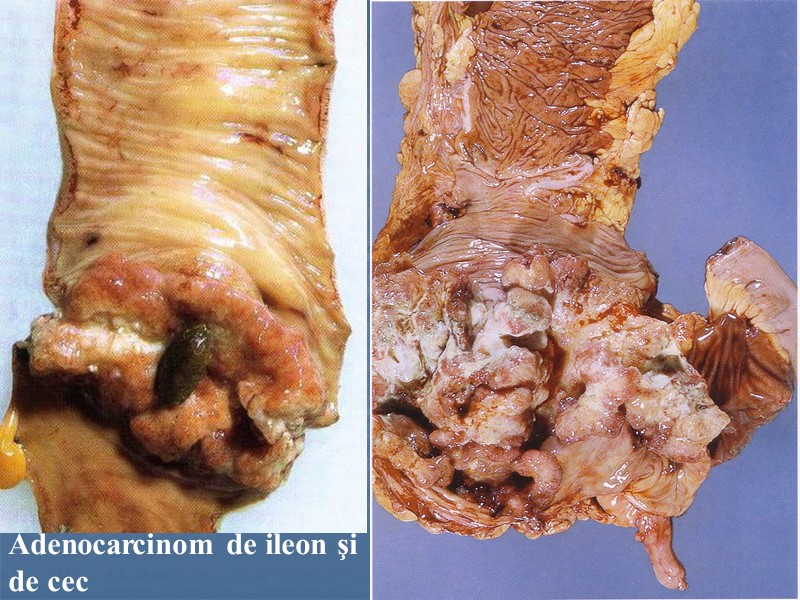 Adenocarcinom de ileon şi  de cec